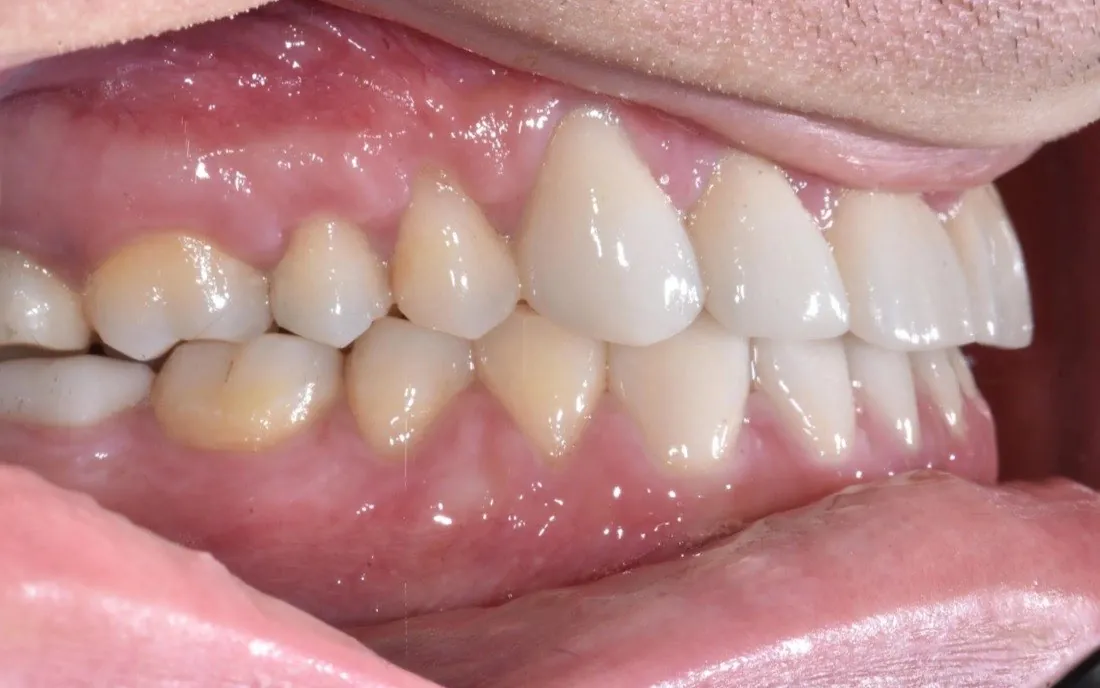 The same patient’s teeth and bite after interdisciplinary orthodontic treatment