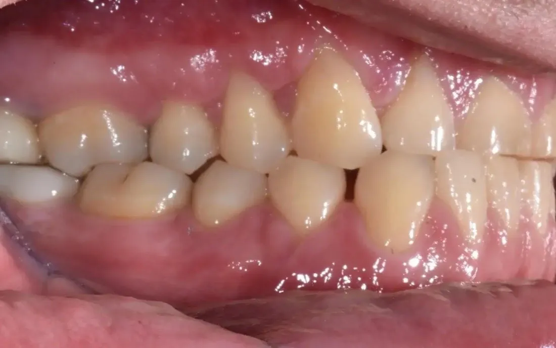 A patient’s teeth and bite before interdisciplinary orthodontic treatment