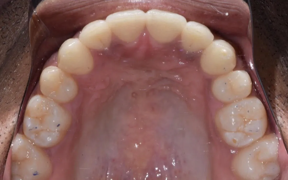 The same view after aligner treatment, the upper arch even and rounded