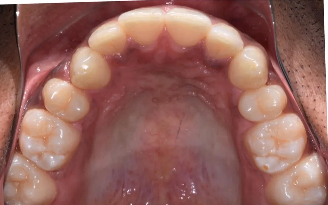 A view up into a patient’s upper arch before aligner treatment, the front teeth crowded and rotated