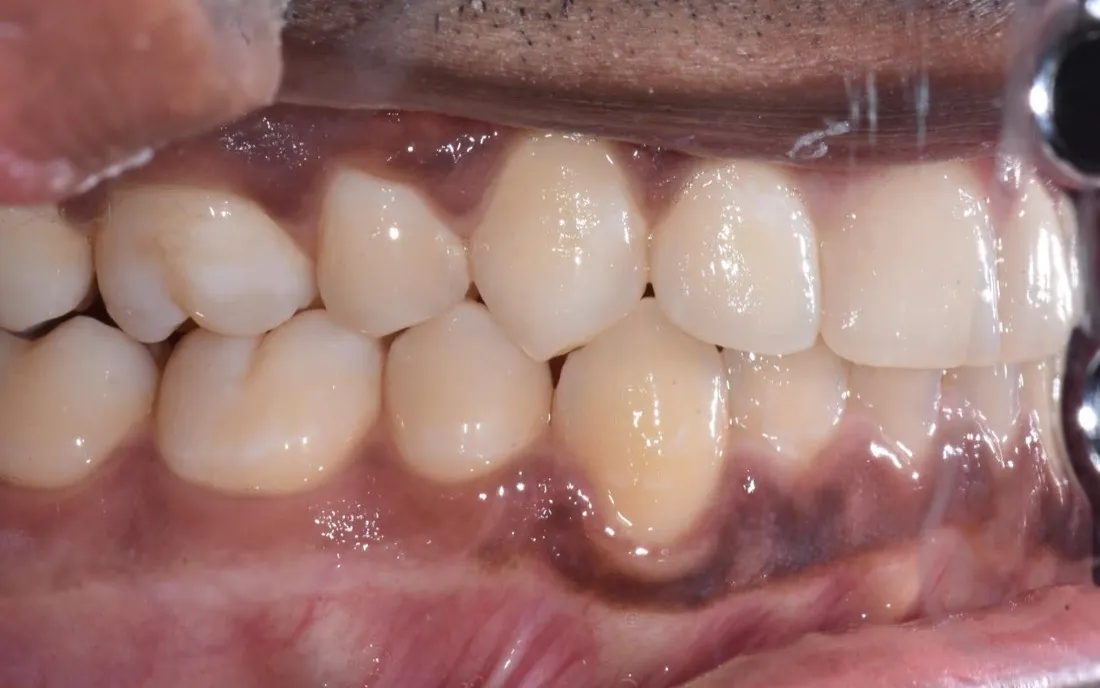 The same side view after aligner treatment, the teeth in line along the arch