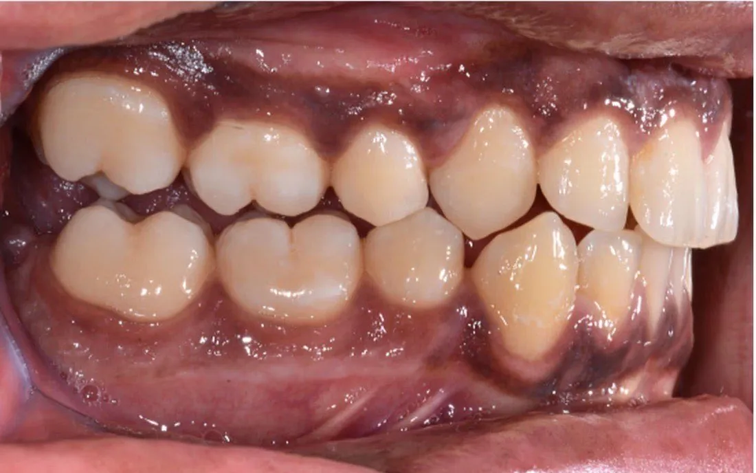 A side view of a patient’s teeth before aligner treatment, an upper tooth sitting out of the arch