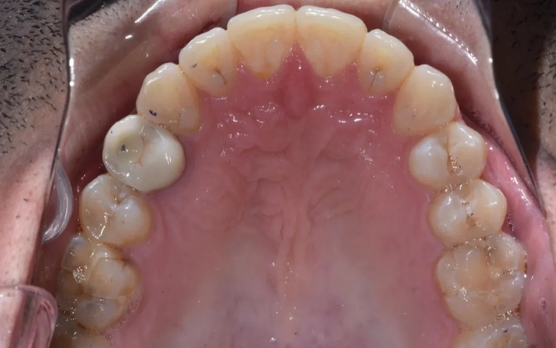 The same view after aligner treatment, the front teeth level and evenly spaced