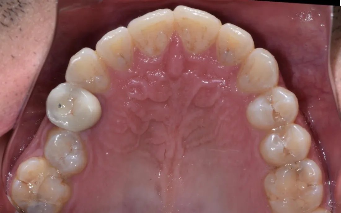 A view up into a patient’s upper arch before aligner treatment, the front teeth overlapping