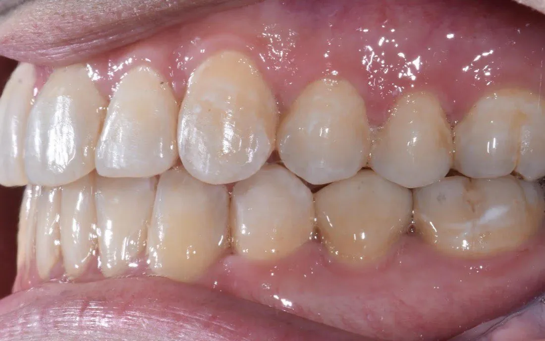 The same side view after aligner treatment, the teeth meeting along the arch