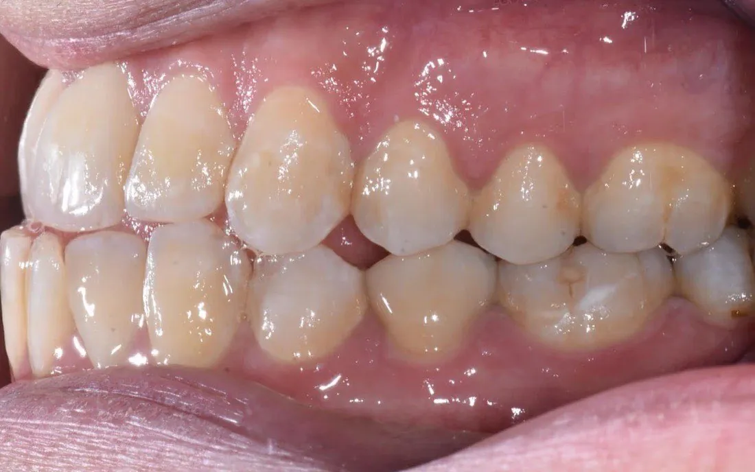 A side view of a patient’s teeth before aligner treatment, the upper and lower teeth not meeting evenly