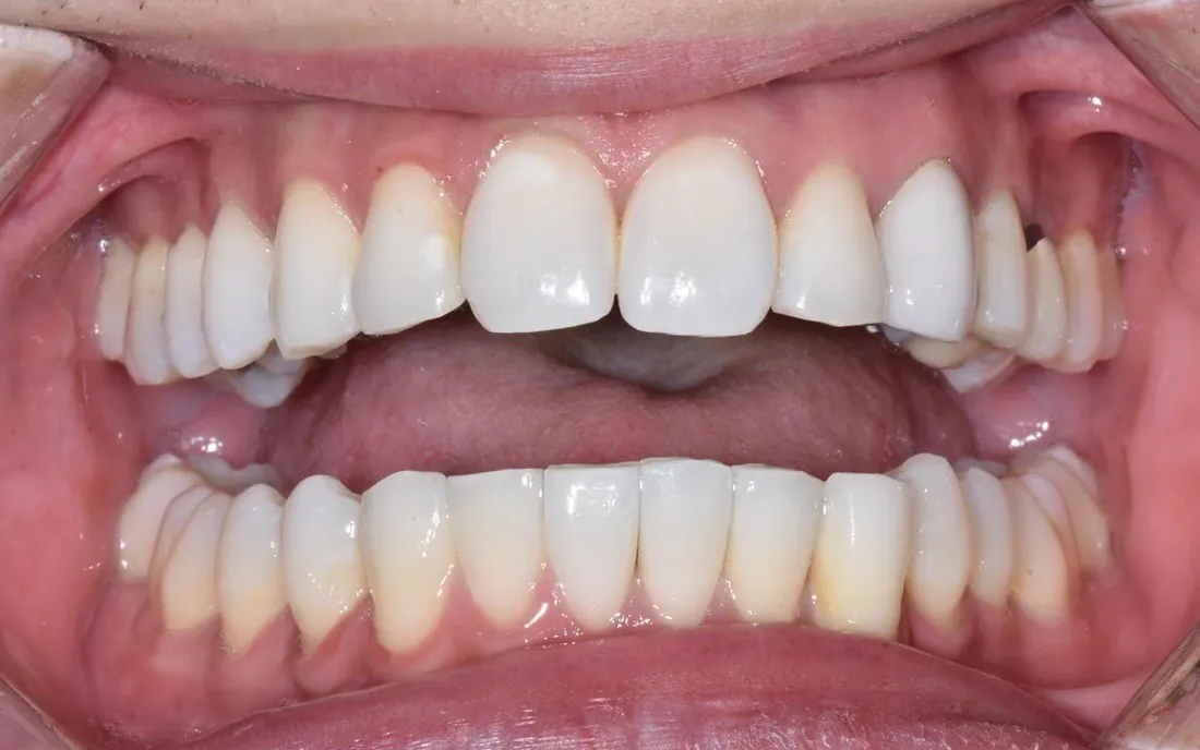 The same front view after treatment, the teeth aligned and no appliance visible from the front
