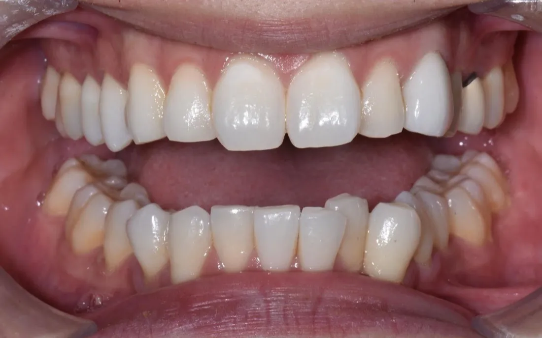A front view of a patient’s teeth before lingual braces, the lower front teeth crowded