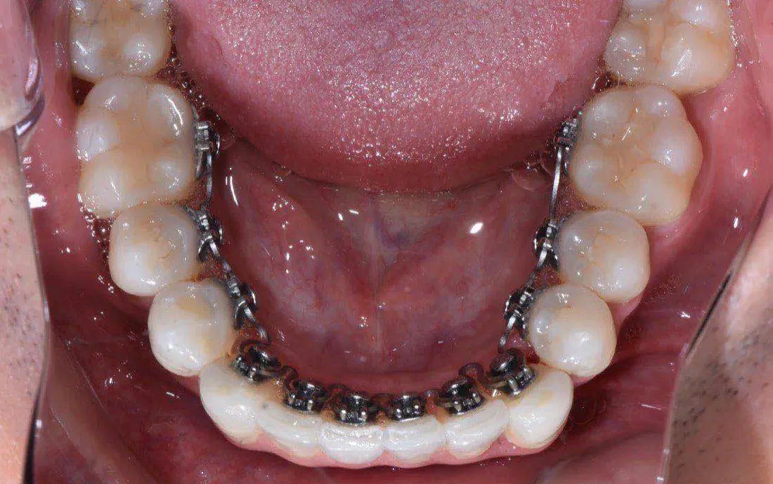 The same lower arch with lingual brackets and an archwire bonded behind the teeth