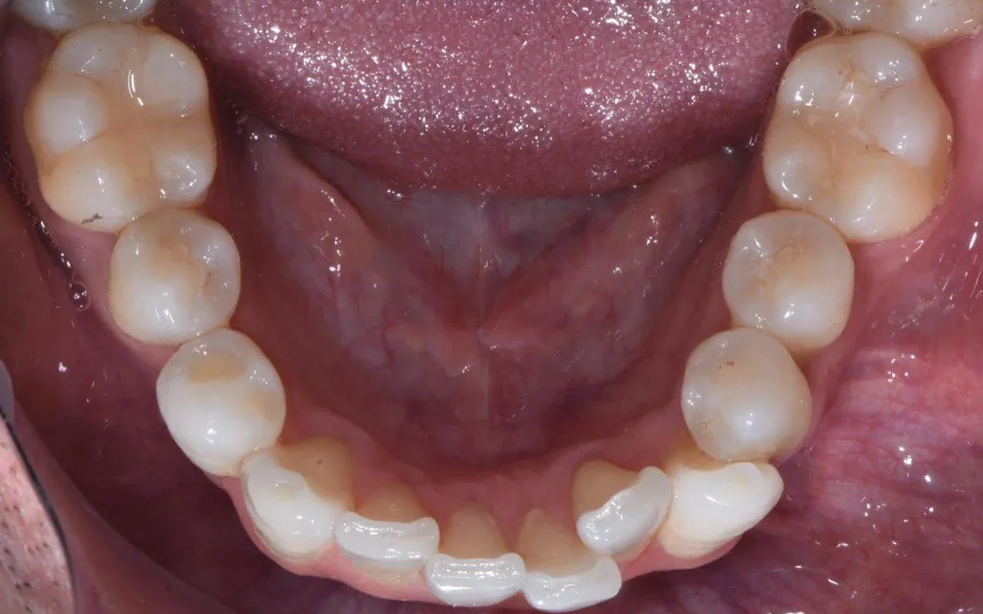 A view down onto the same patient’s lower teeth before treatment