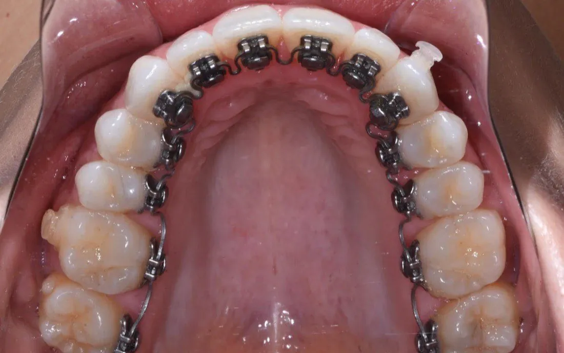 The same upper arch with lingual brackets and an archwire bonded behind the teeth