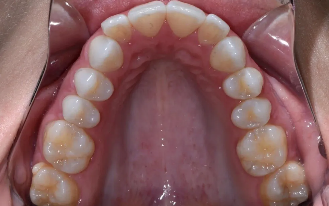 A view up into a patient’s upper arch before treatment