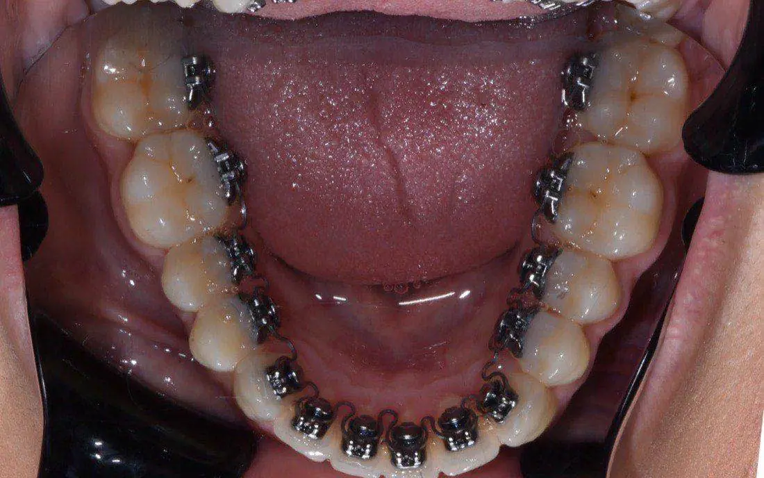 The same lower arch with lingual brackets and an archwire bonded behind the teeth