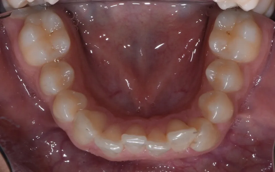 A view down onto a patient’s lower teeth before treatment
