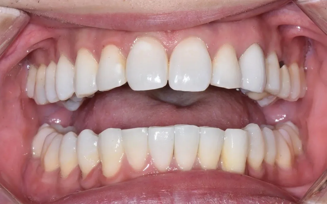The same patient’s teeth after lingual braces treatment