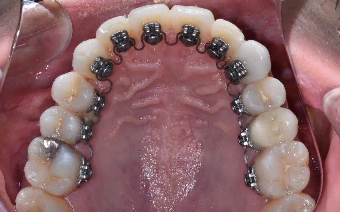 The same patient’s teeth after lingual braces treatment