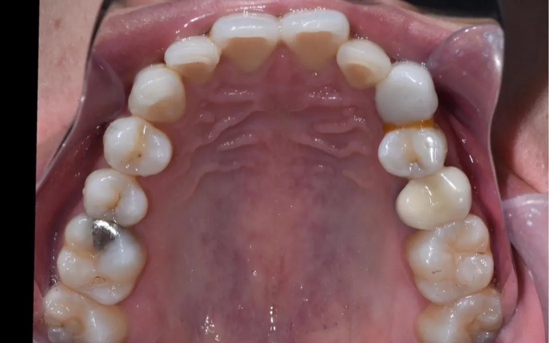 A patient’s teeth before lingual braces treatment