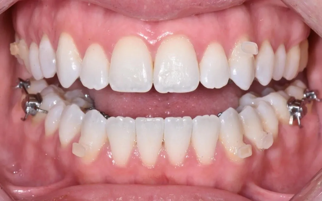 The same patient’s teeth after lingual braces treatment
