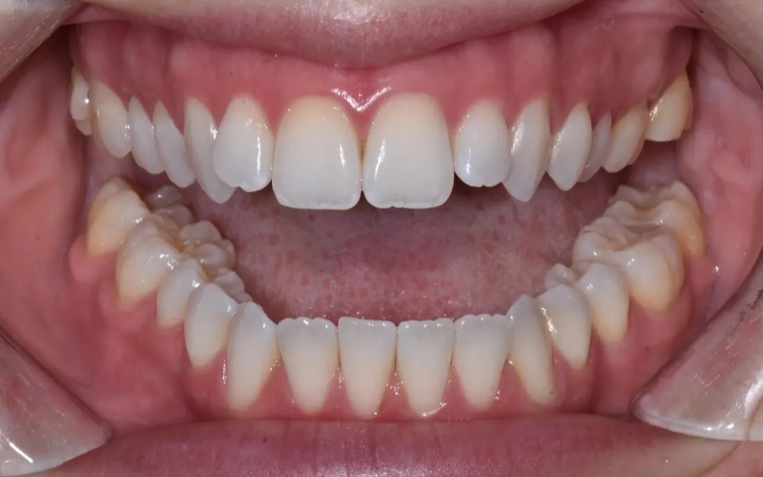 A patient’s teeth before lingual braces treatment