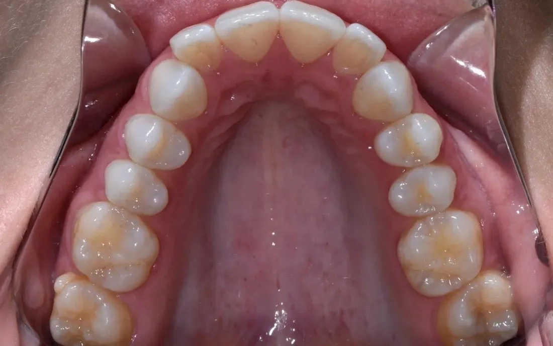 A patient’s teeth before lingual braces treatment