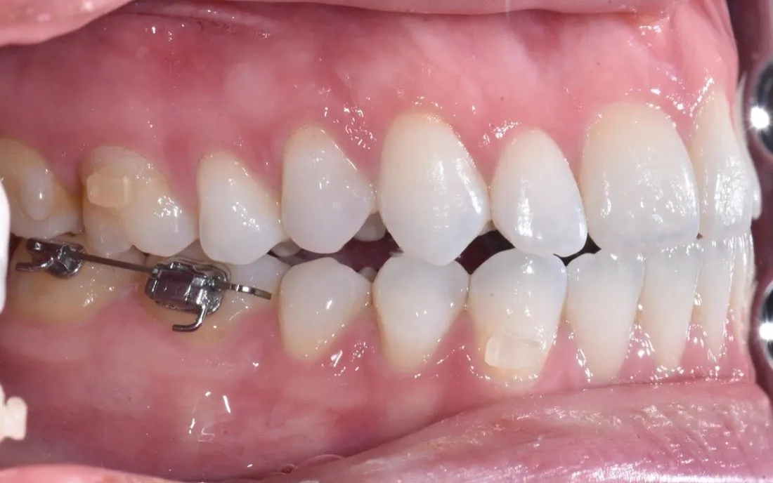 The same patient’s teeth after lingual braces treatment