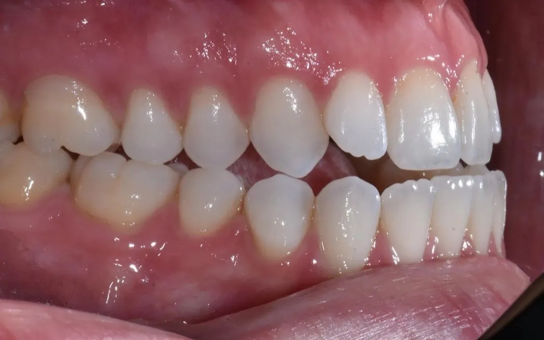A patient’s teeth before lingual braces treatment