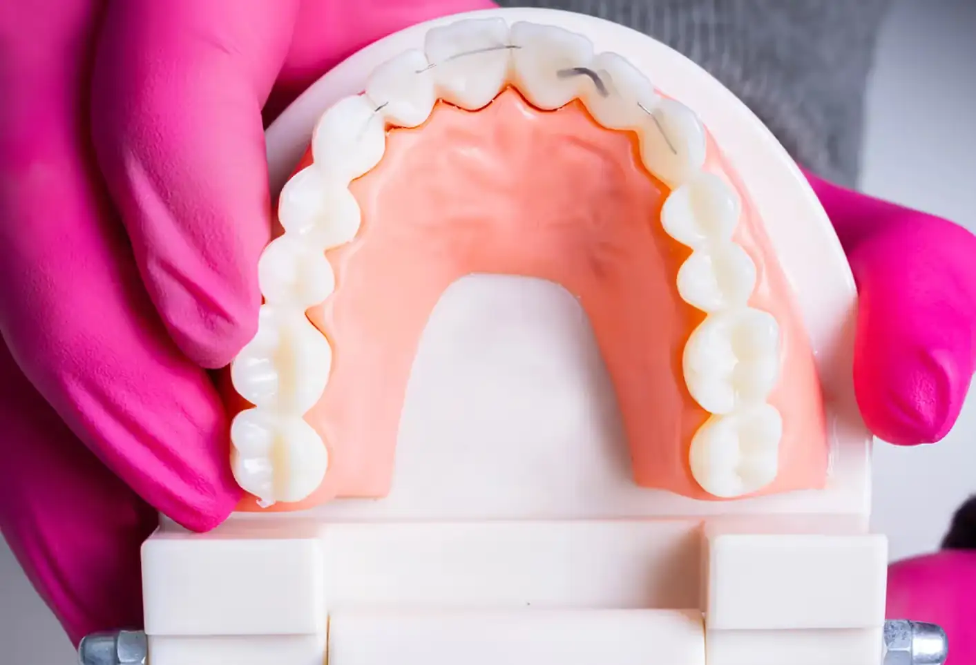 C5 Hidden Orthodontics
