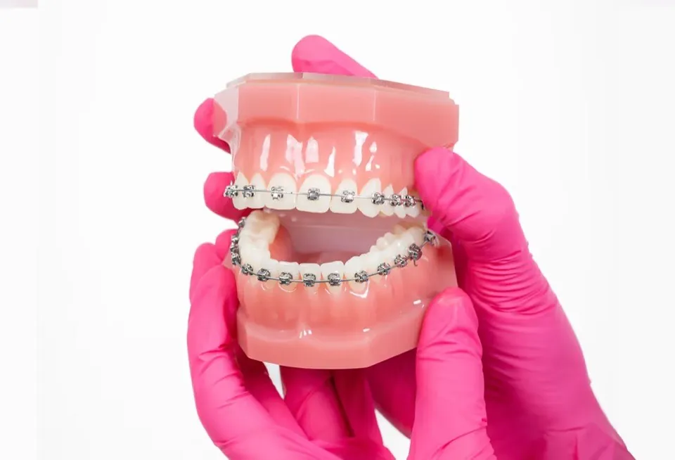 Gloved hands holding a dental model with braces bonded to both the upper and lower arches