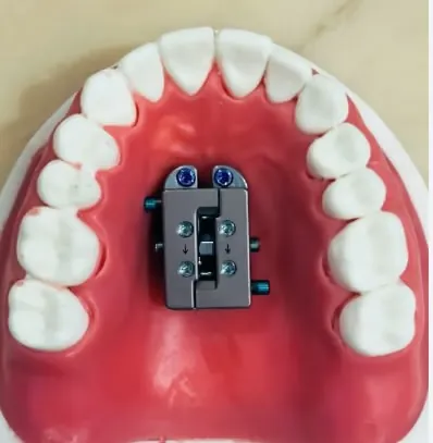 A Facegenics midface expander fitted to the palate of a dental model