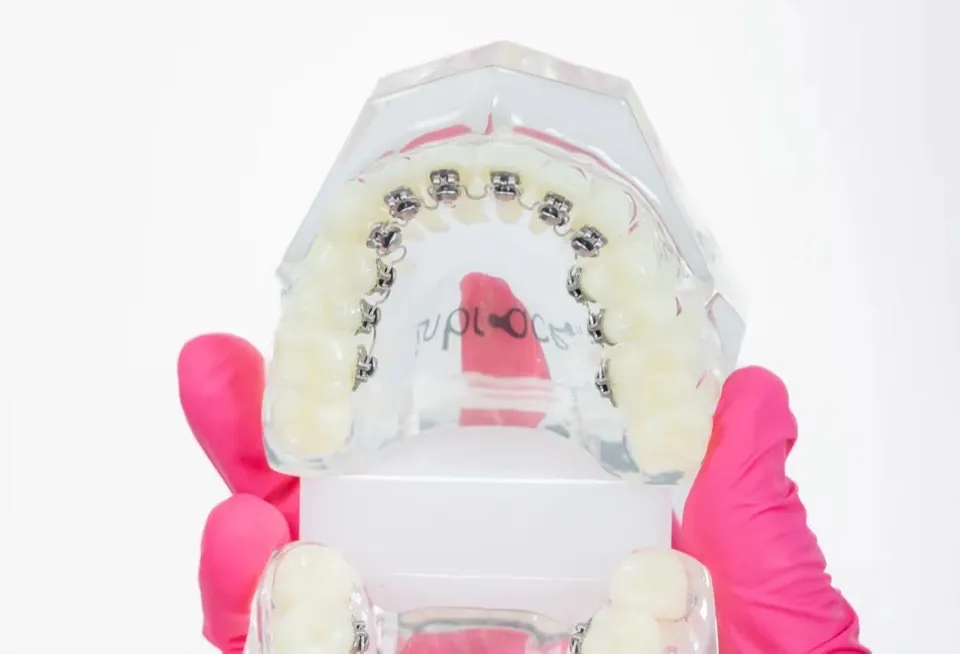 A clear dental model seen from the front, with lingual brackets bonded behind the upper teeth and nothing visible on the outside