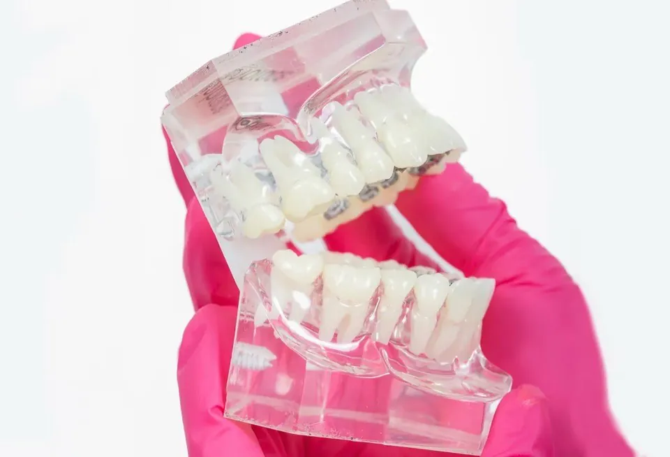 A clear dental model seen from above, showing brackets and an archwire running along the tongue side of the upper teeth