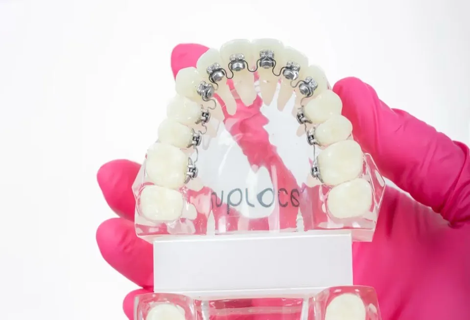 A gloved hand holding a clear dental model fitted with lingual braces while a polishing handpiece is brought to the teeth