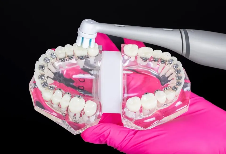 A gloved hand holding an open clear dental model with lingual braces on the upper and lower arches