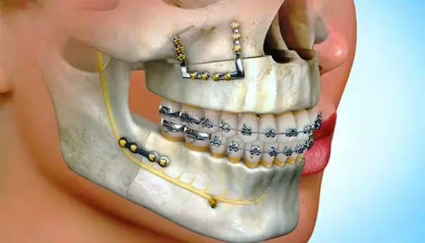 An illustration of surgical plates and braces repositioning the upper and lower jaws